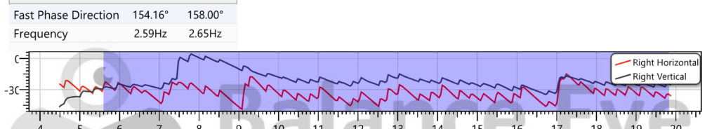 Vestibular Neuritis - Spontaneous Nystagmus