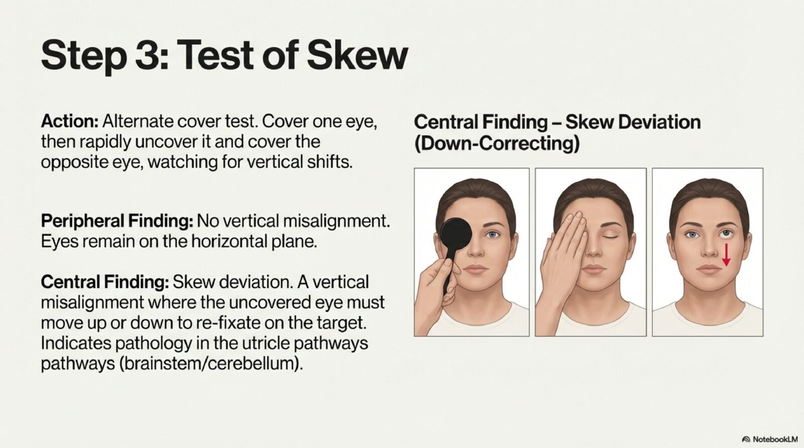 Diagram explaining skew deviation — vertical misalignment of the eyes — as a central sign in the HINTS exam for differentiating stroke from vestibular neuritis