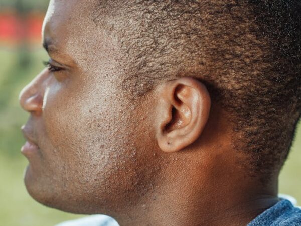 Close-up profile of a man's head showing his ear — vestibular migraine symptoms | Dr. Prateek Porwal, ENT